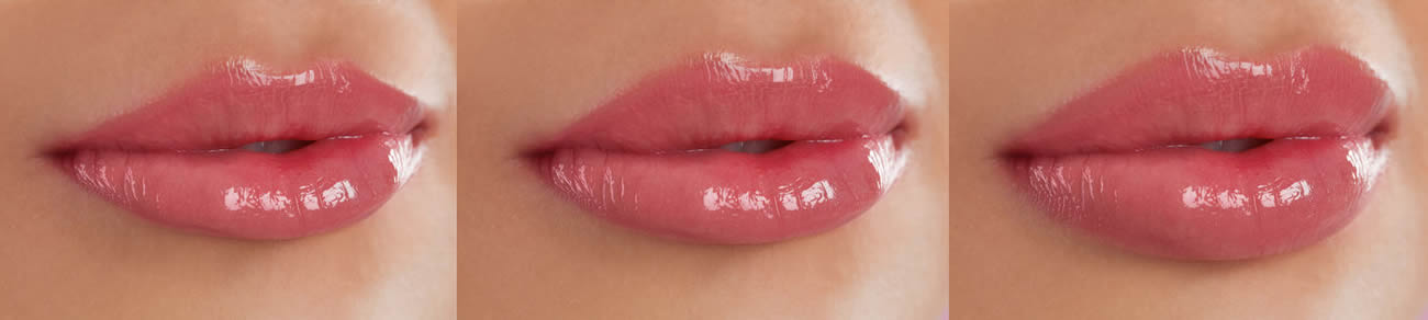 Lip Enhancement Treartments Provided By Artistic Beauty In Nelson NZ